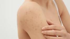 Tips for preventing scabies during the monsoon season
								